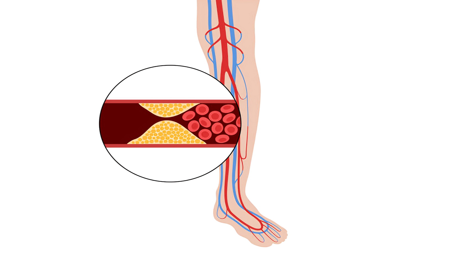 Peripheral Artery Disease Treatment in Secunderabad